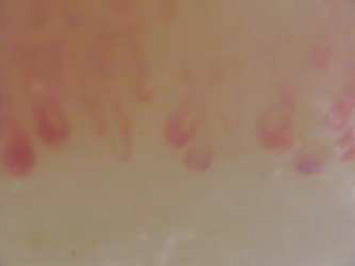 Intravascular Large B-Cell Lymphoma Presenting as Systemic Capillary Leak Syndrome With Immunological Phenomena: A Case Report.