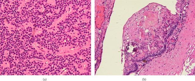 Pituitary Macroadenoma and Adamantinomatous Craniopharyngioma: A Rare Case Report of Sellar Collision Tumors.