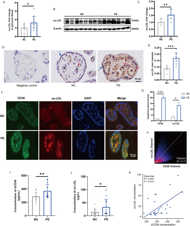 Fatty Acid Transporter CD36 Promotes Ox-LDL-Induced Senescence of Vascular Endothelial Cells in Preeclampsia.