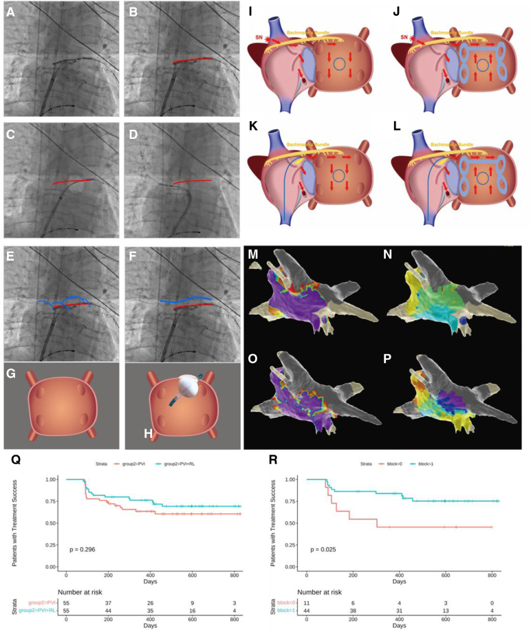 Cryoballoon Roof Line and Pulmonary Vein Isolation for Persistent Atrial Fibrillation: A Randomized Trial.