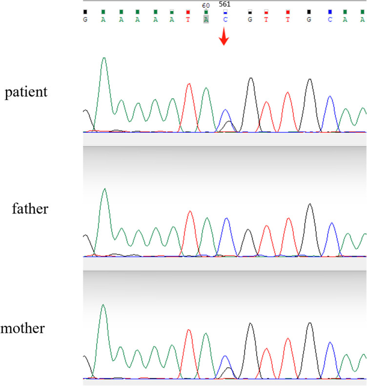 Novel lamin B receptor mutation (c.561C > G) in a patient with Pelger-Huët anomaly: a case report.