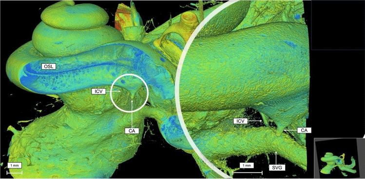 Volume rendering technique and high-resolution microCT: 3D exploration of the cochlear anatomy.