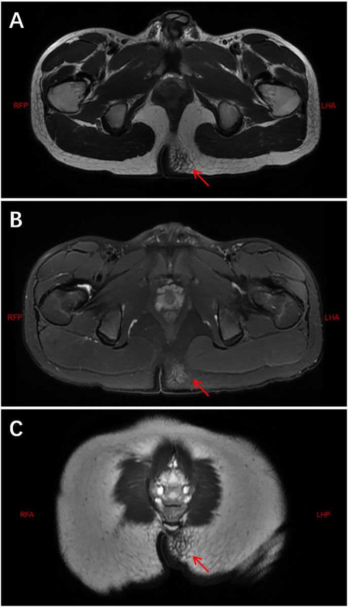 Inflammatory myofibroblastic tumors in children: a single-center retrospective study of clinical features, management, and outcomes.