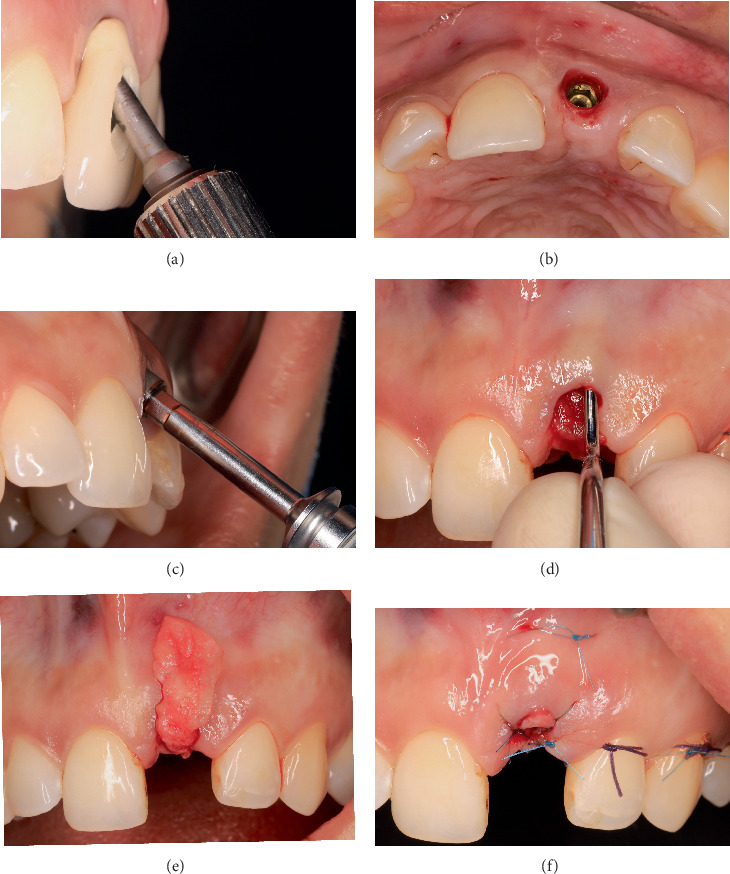 Interdisciplinary Management of Biological and Prosthetic Implant Complications in the Esthetic Zone: A Case Report.