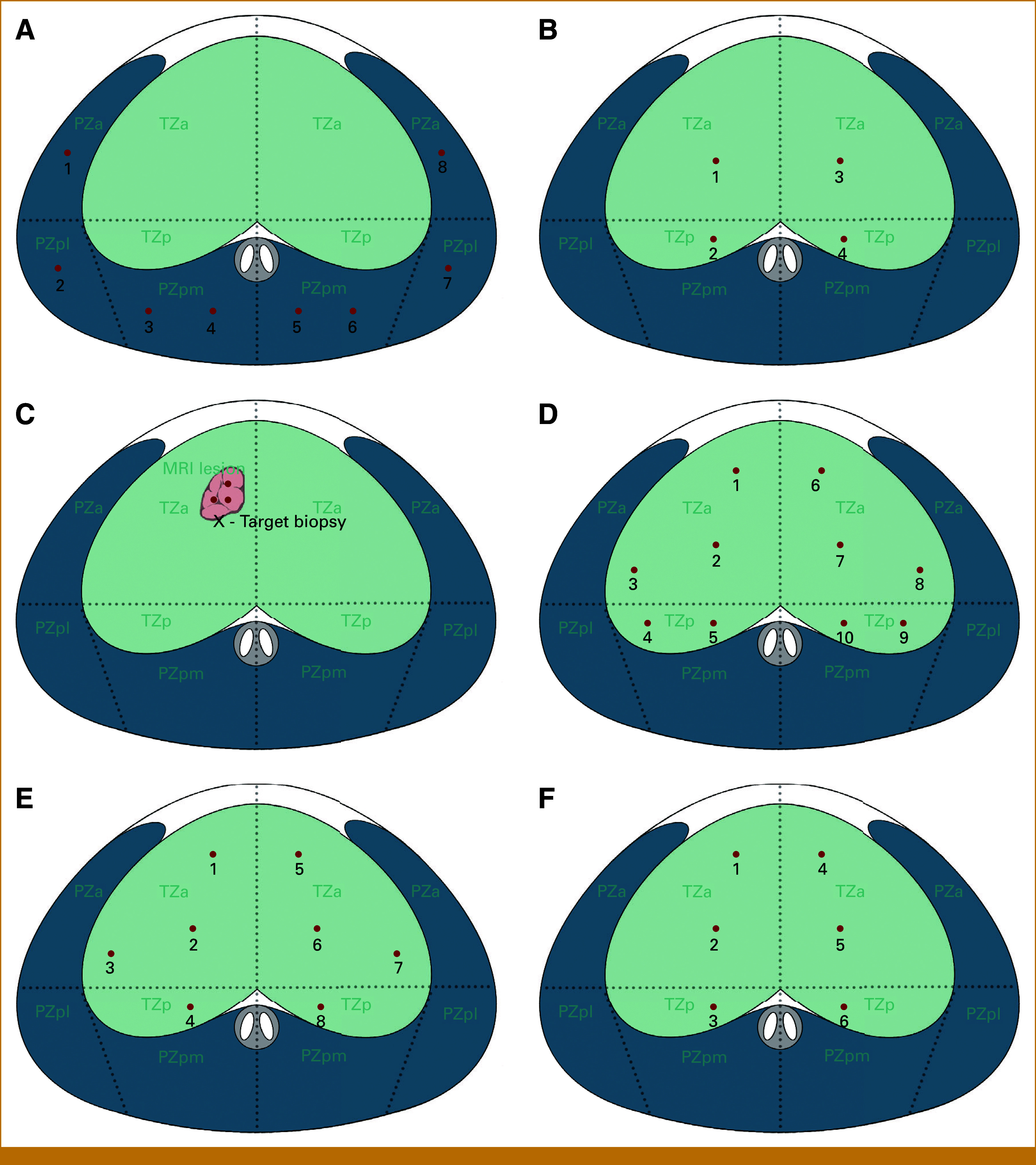 Optimized Biopsy Strategy for Transition Zone Prostate Cancer With Enhanced Perilesional Sampling: A Retrospective Analysis and Clinical Trial Validation.