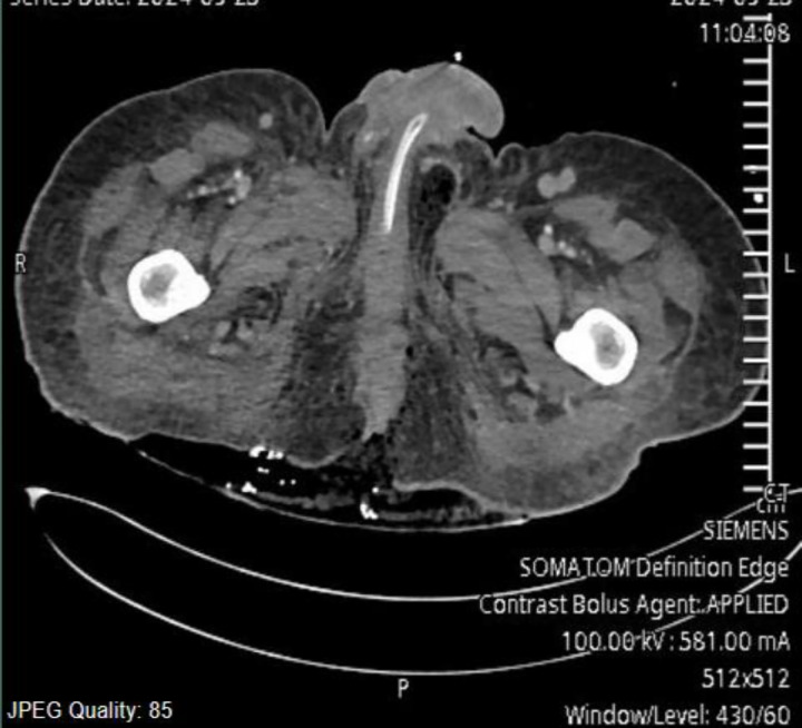 Eustachian valve endocarditis in patients with Fournier's gangrene and septic shock: A rare case and a literature review.