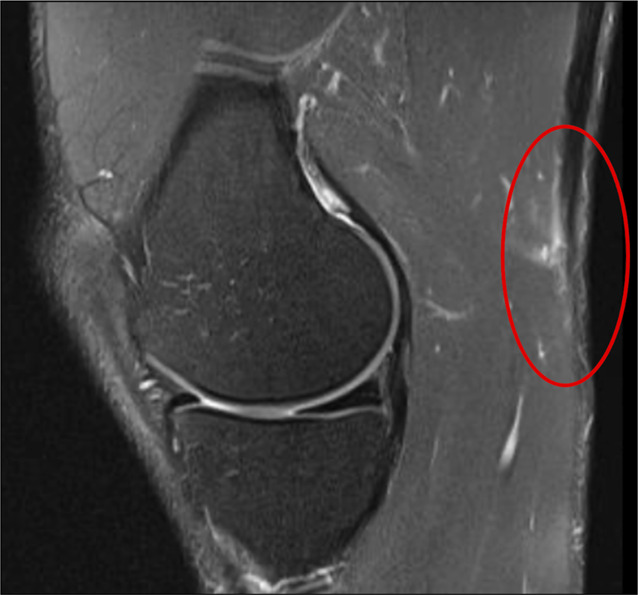 Distal Hamstring Injuries and Disorders.