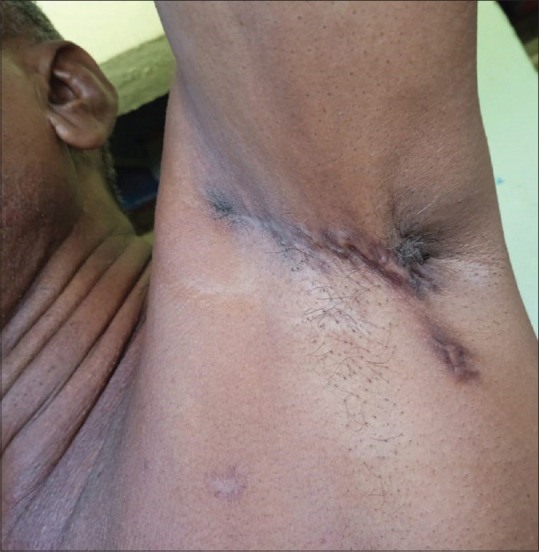 Primary Cutaneous Mucinous Carcinoma: A Rare Entity.