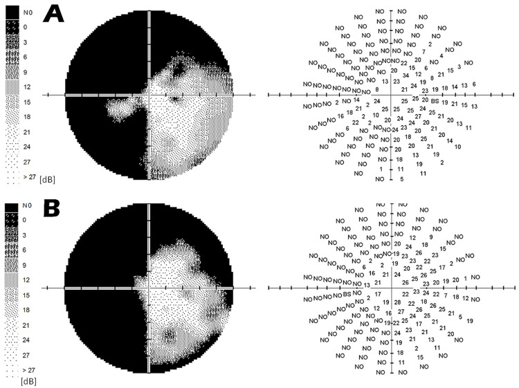 Septo-Optic Dysplasia Plus with Bilateral Homonymous Hemianopia - Case Report.