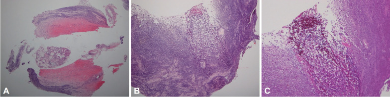 A Case of Black Esophagus in a Patient Presenting With Dyspnea.