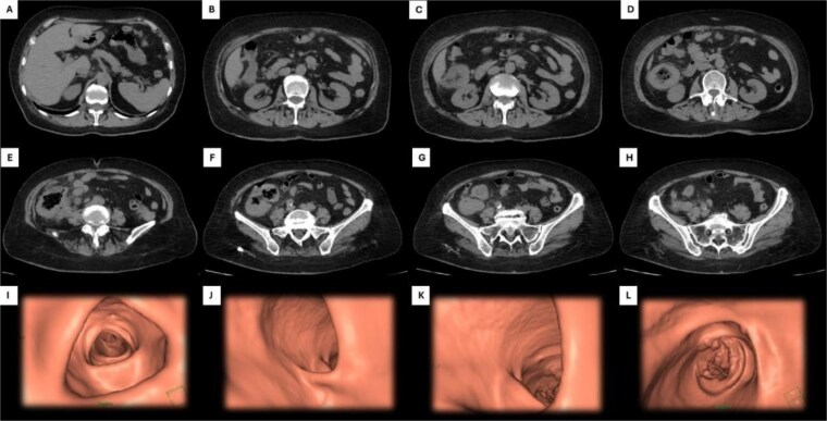 Primary colonic lymphoma: clinical dilemmas in diagnosis and treatment strategy.