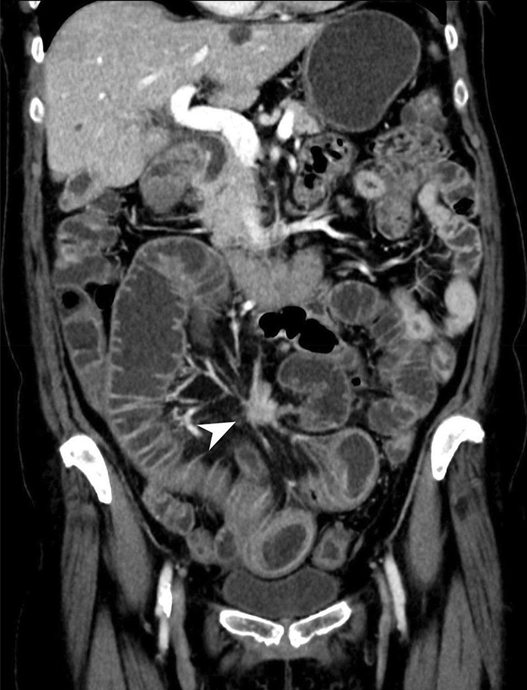Neuroendocrine Small Bowel Tumor.