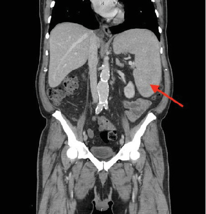 KIT-Negative Systemic Mastocytosis Associated With Acute Myeloid Leukemia.