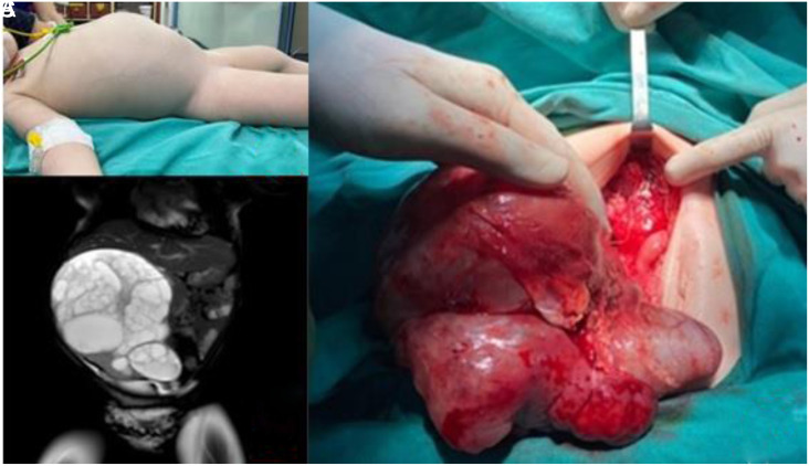 Massive Cystic Nephroma in a 13-Month-Old Girl: Case Report and Differential Diagnostic Outcome.