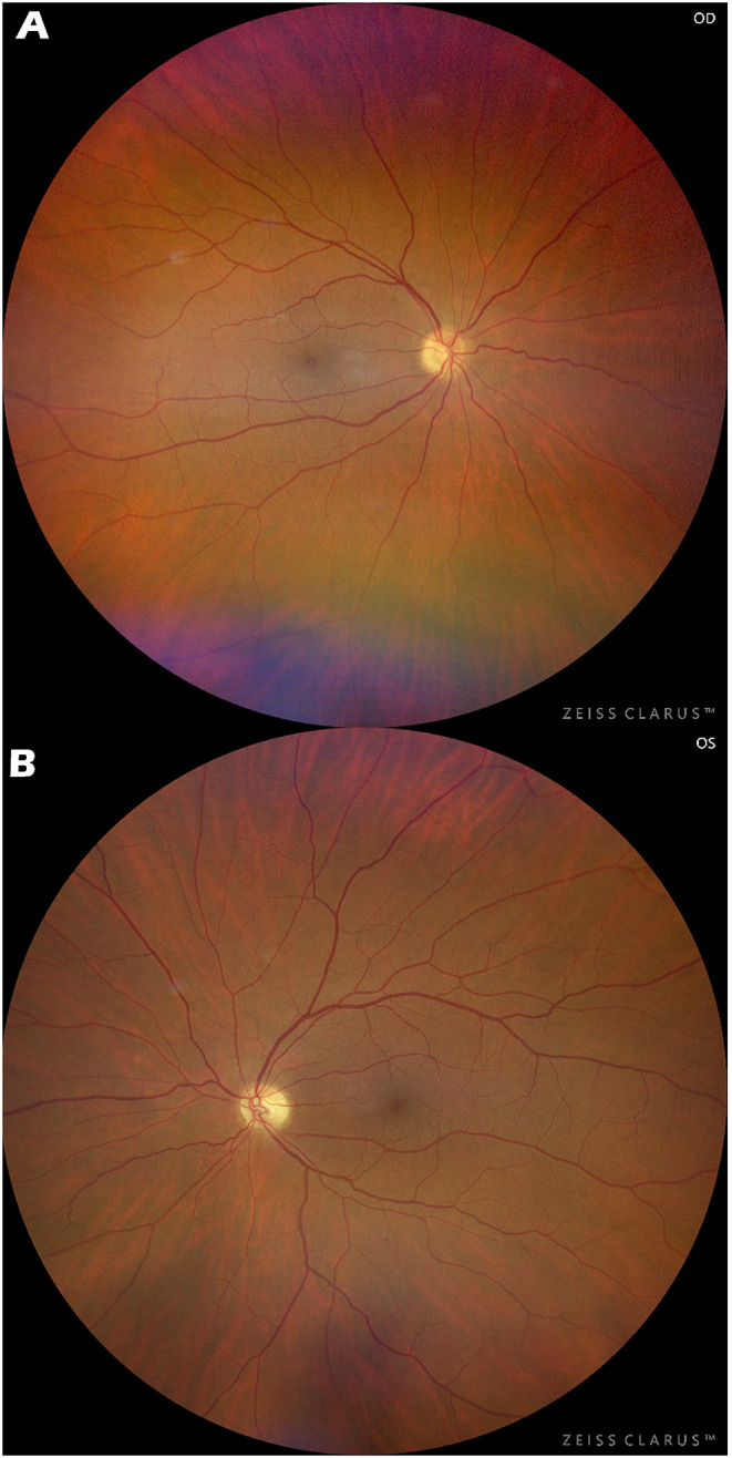 Septo-Optic Dysplasia Plus with Bilateral Homonymous Hemianopia - Case Report.