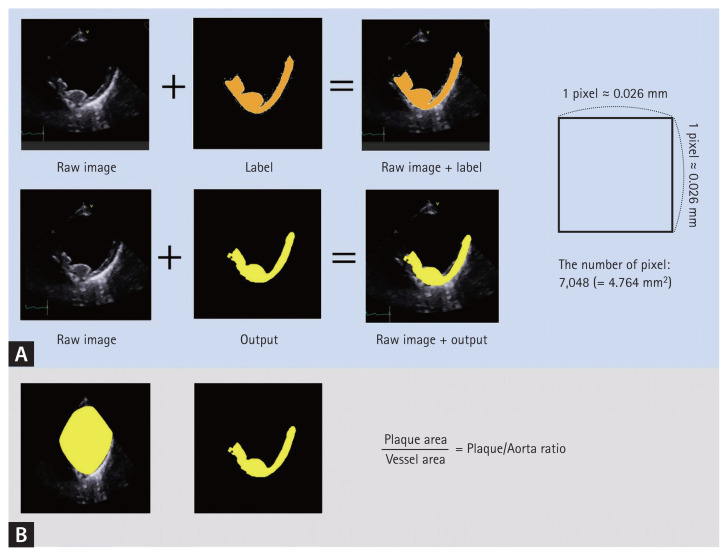 Automatic quantitative analysis of atherosclerotic aortic plaques in patients with embolic cerebral infarction using deep learning.