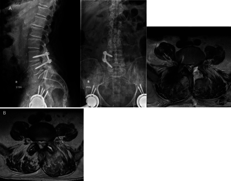 Nocardia facet sepsis, an indicator of immunocompromise: illustrative case.