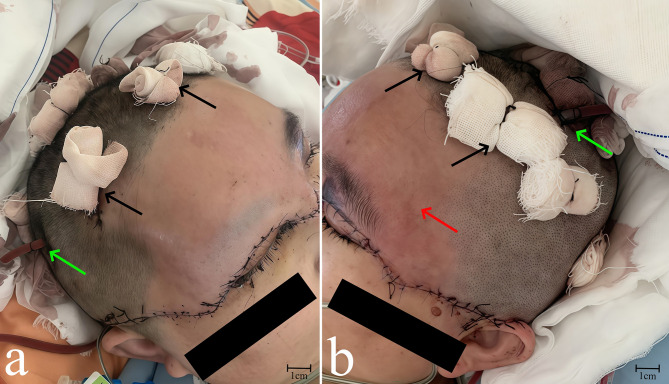Treatment of severe scalp avulsion injury through microsurgical vascular anastomosis, subarea multi-tubenegative pressure drainage, and anchoring sutures: a case report.