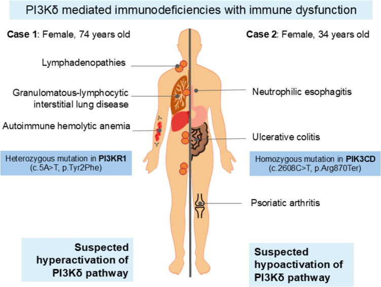 The double-edged sword of PI3Kδ pathway-related immune dysregulation: insights from two case reports.