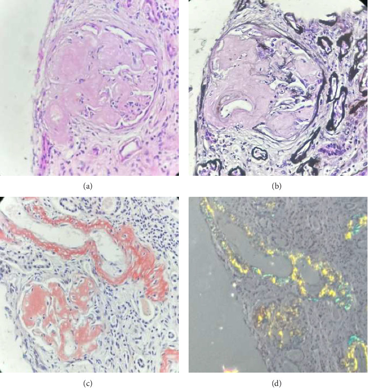 Acquired Renal Amyloidosis in a Patient With X-Linked Hyper-IgM Immunodeficiency With Novel Hemizygotic Pathogenic Variant in CD40LG Gene.