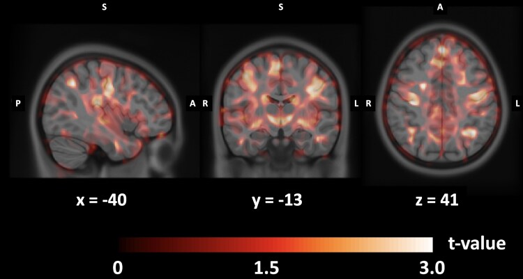 Alterations of the neural substrate in childhood apraxia of speech: new evidence from neuroimaging.