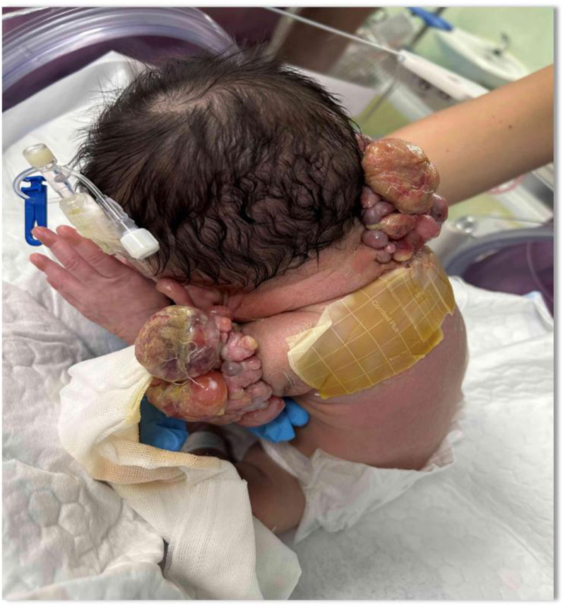 Case Report: Multidisciplinary management and nursing care for a preterm infant with rare extrarenal malignant rhabdoid tumor: a clinical case study.