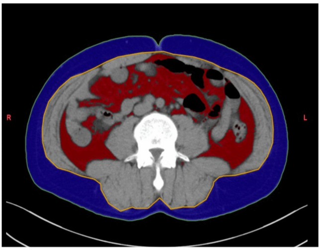 Visceral obesity as a predictor of ileal pouch reachability in ulcerative colitis: A prospective single-center study.