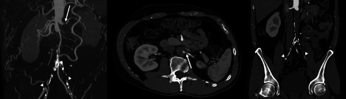 Neuroimaging in PRES: Isolated Brainstem and Spinal Cord Involvement Secondary to Aorto-Iliac Occlusive Disease-A Unique Case Report.