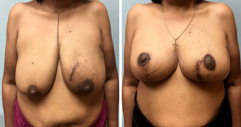 Excess Horizontal Breast Skin Facilitates a Simpler Wise Pattern Split Reduction Incision for Superficial Cancers.