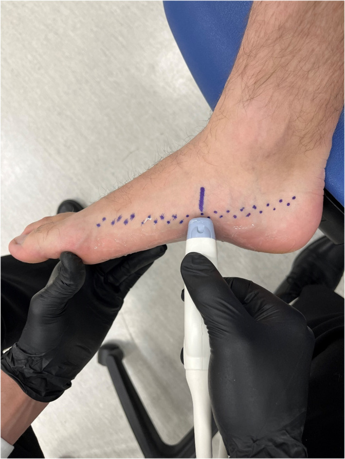 Validity of MRI and Ultrasound Volume Measurements of Foot Muscles and Plantar Fascia Cross-Sectional Area Within Older Adults With and Without Chronic Plantar Fasciitis.