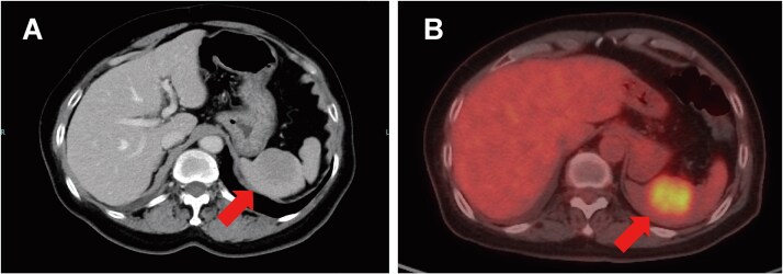 Isolated splenic metastasis presenting at diagnosis of HER2-positive <i>de novo</i> metastatic breast cancer: a case report.