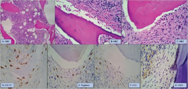KIT-Negative Systemic Mastocytosis Associated With Acute Myeloid Leukemia.