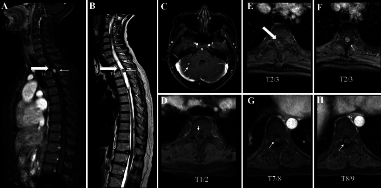 The gradual expansion of multiple intramedullary metastatic renal cell carcinoma in a patient with von Hippel-Lindau disease with multiple intramedullary hemangioblastomas: illustrative case.