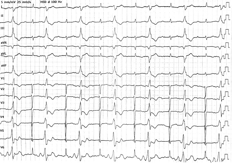 Combined transapical transcatheter aortic valve implantation and premature ventricular contraction ablation in a high-risk cardiomyopathy patient: a case report.