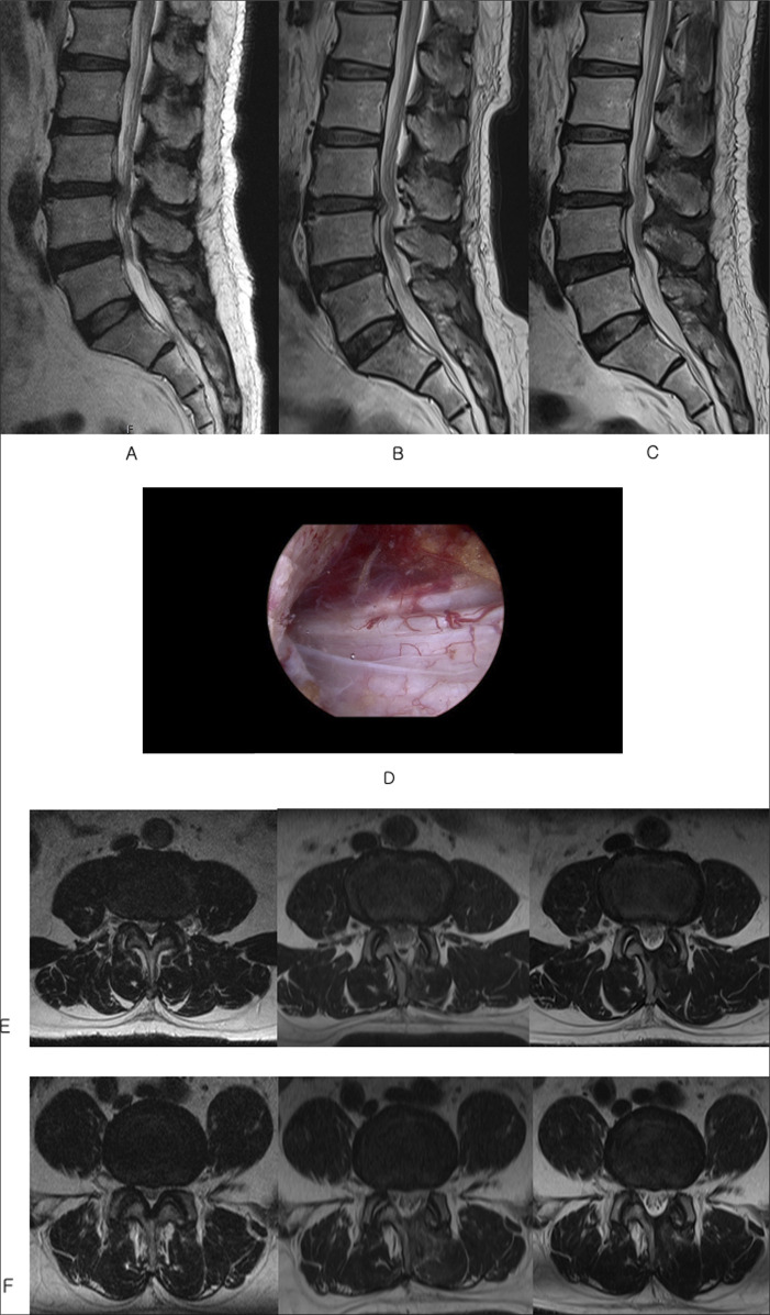 Equivalent Patient-Reported Clinical Outcomes Between Single-Level and Multilevel Biportal Endoscopic Decompression at 5-Year Follow-up.
