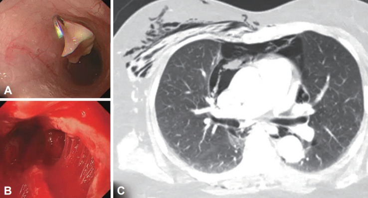 Esophageal Rupture Occurred During the Endoscopic Removal of a Lodged Denture.