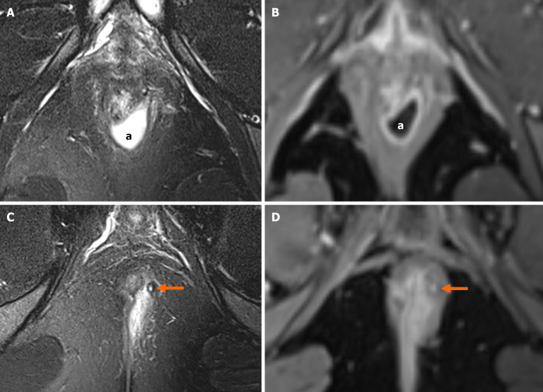 Imaging in perianal fistulising Crohn's disease: A practical guide for the gastroenterologist.
