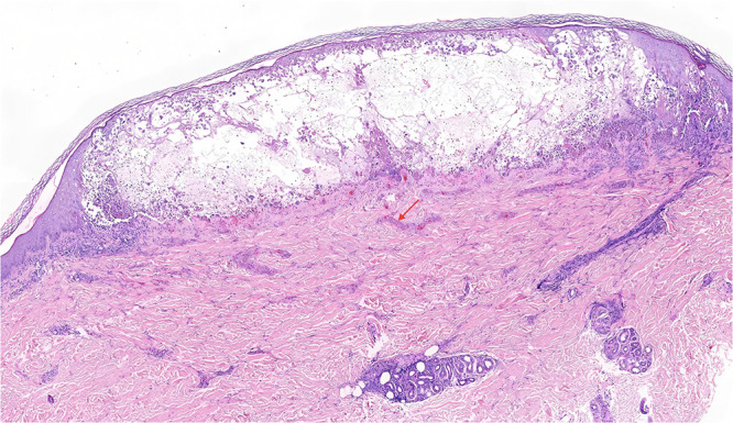 A Case of Generalised Varicella in an Adult.