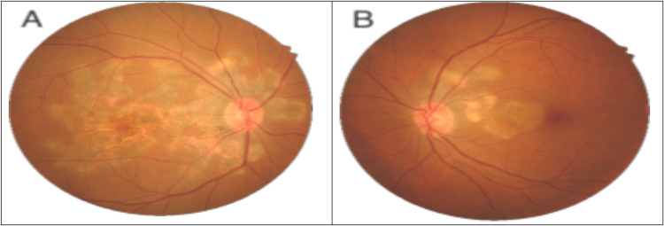 The Role of Adding Intravitreal Dexamethasone Implant to the Standard Management of Serpiginous Choroiditis for Achieving Rapid Remission: A Case Report.