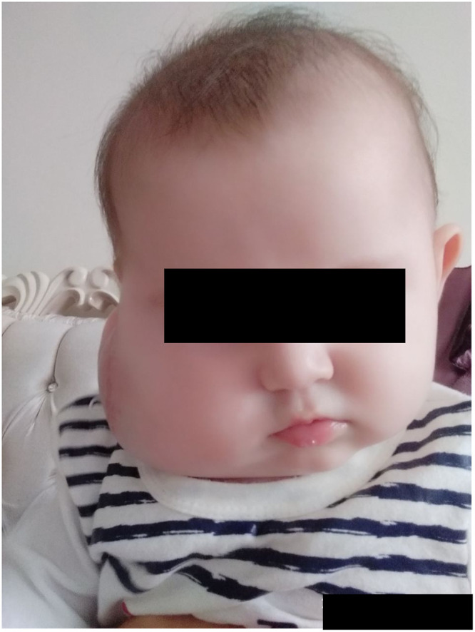 Metronomic Chemotherapy in the Treatment of Infantile Parotid Hemangioma - A Case Report.