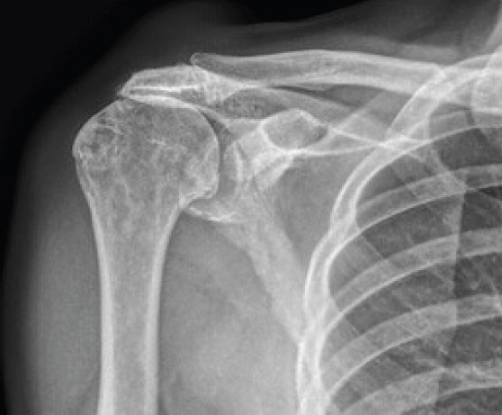 A Silent Shoulder of Plentiful Pathology: An Uncommon Presentation of Acromioclavicular Ganglion Cyst.