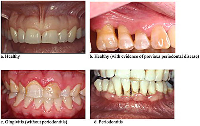 Accuracy of digital photographs for assessing inflammatory gum disease in epidemiologic studies.