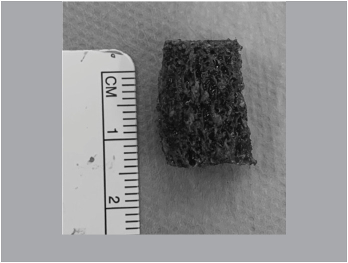 PLATE USING CANCELLOUS GRAFT VERSUS SCREW USING CANCELLOUS CORTICAL GRAFT IN THE TREATMENT OF SCAPHOID PSEUDARTHROSIS.