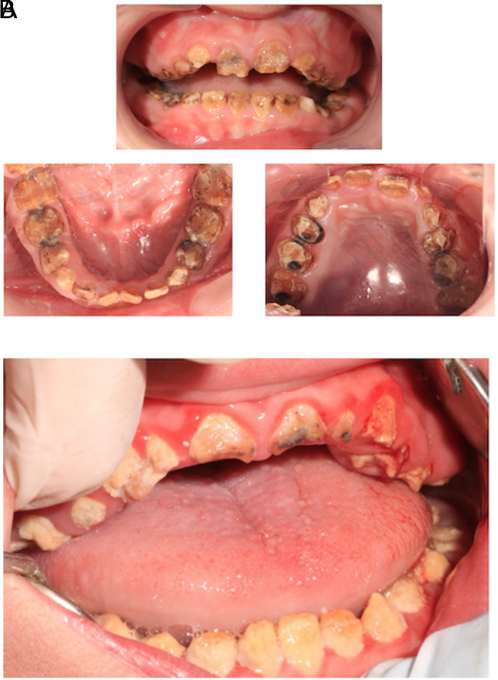 Kohlschütter-Tönz Syndrome: A Rare Clinical Entity with Amelogenesis Imperfecta in Two Siblings, Dental Management and Scoping Review.
