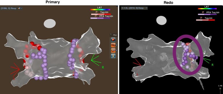 Dual energy for pulmonary vein isolation using focal ablation technology integrated with a three-dimensional mapping system: SmartfIRE 12-month results.
