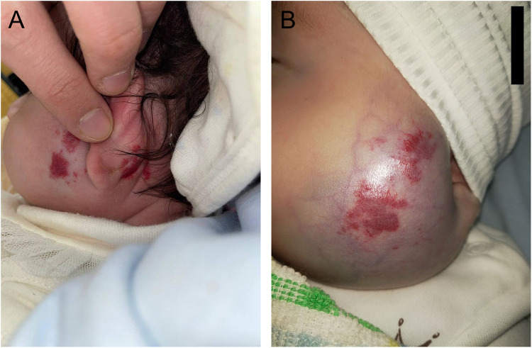 Metronomic Chemotherapy in the Treatment of Infantile Parotid Hemangioma - A Case Report.