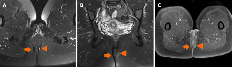 Imaging in perianal fistulising Crohn's disease: A practical guide for the gastroenterologist.