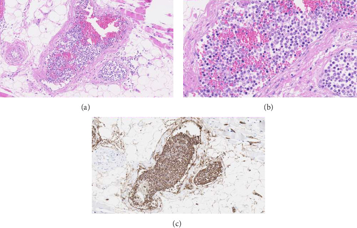 Intravascular Large B-Cell Lymphoma Presenting as Systemic Capillary Leak Syndrome With Immunological Phenomena: A Case Report.