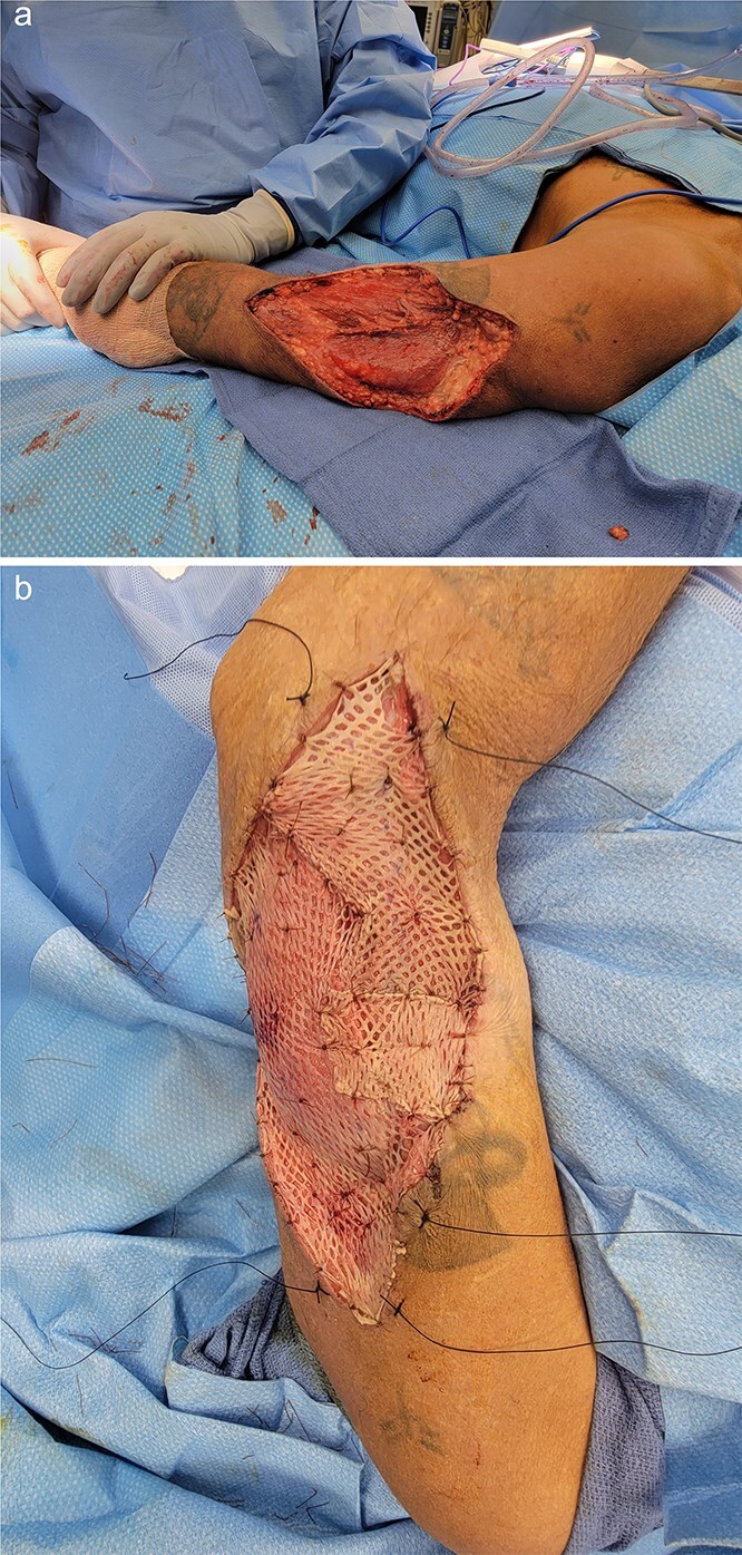 Skin adnexal tumor pilomatrix disease: a transformation from benign to malignant.
