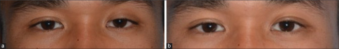 Impact of unilateral Mueller's muscle conjunctival resection on contralateral upper eyelid position in patients without preoperative Hering's effect.